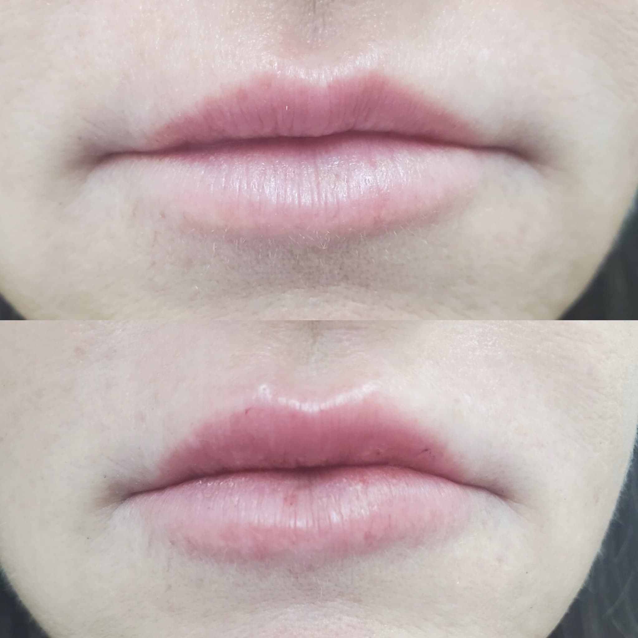 Dermal Filler before and after results