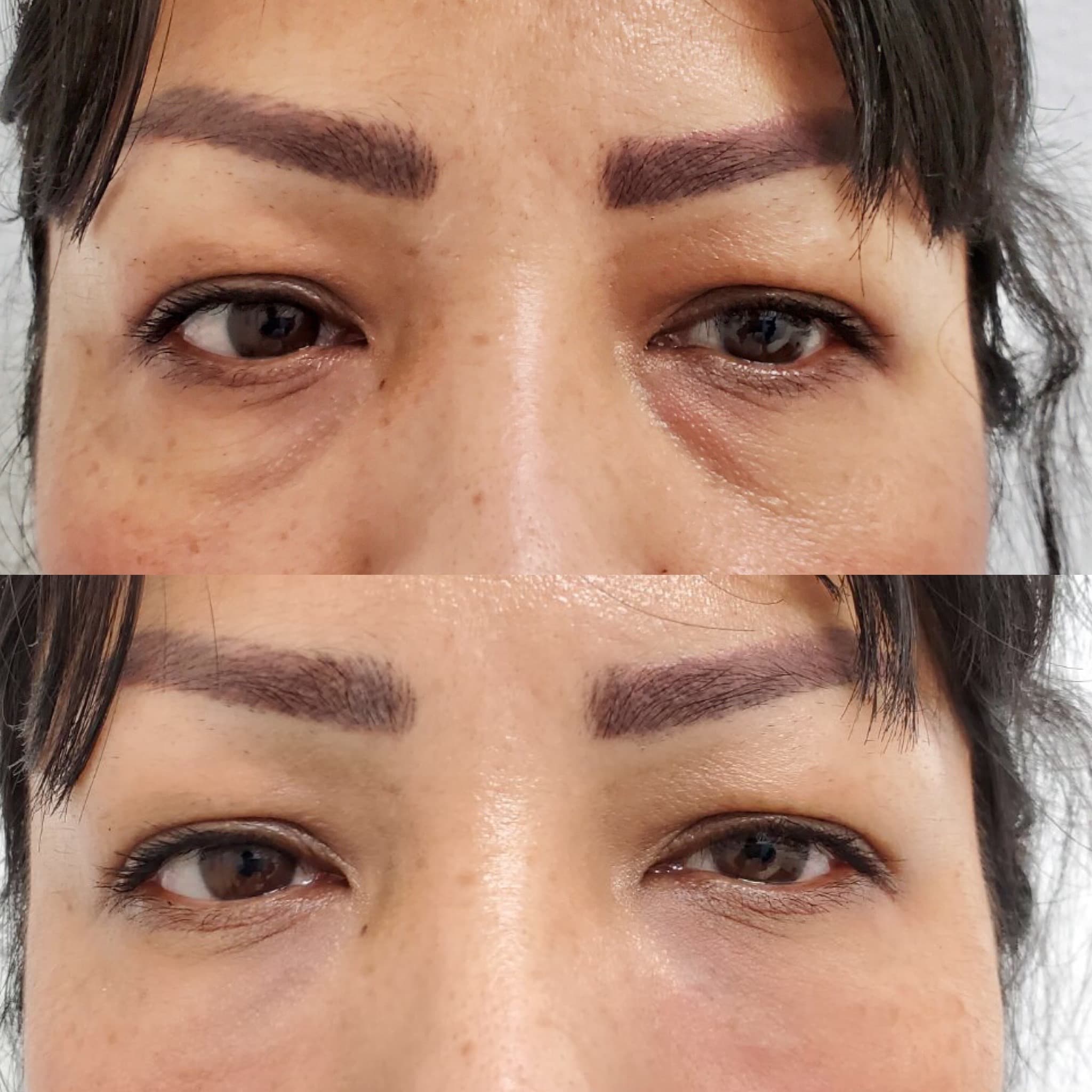 Dermal Filler before and after results