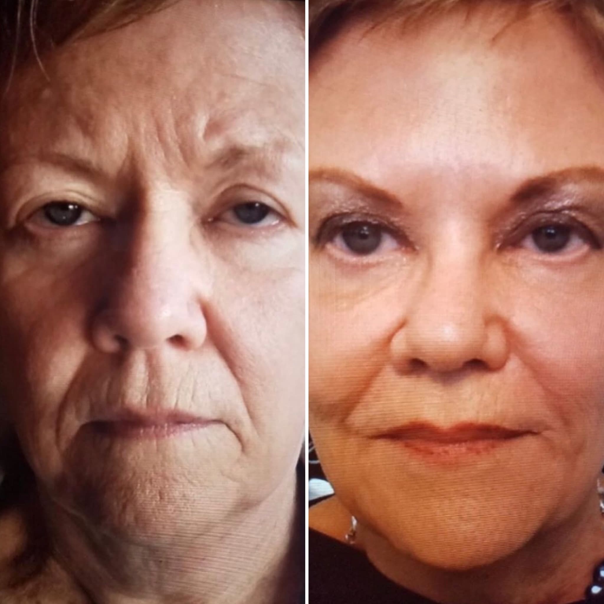 Liquid Facelift before and after results