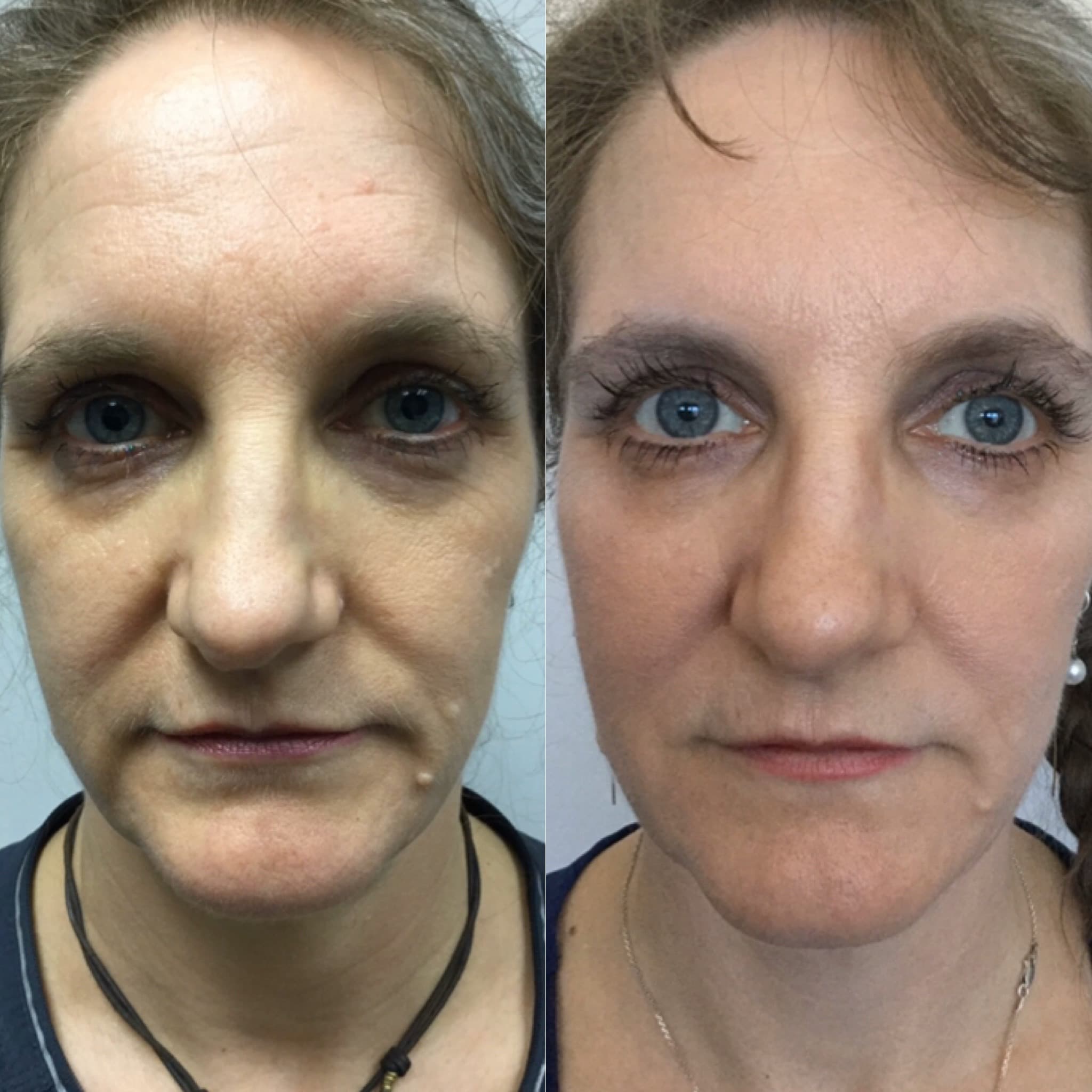 Liquid Facelift before and after results